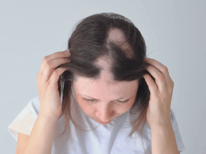 Schuppenflechte Kopfhaut: Ursachen, Behandlung & Tipps