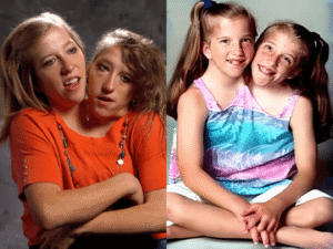 abby und brittany hensel tot
