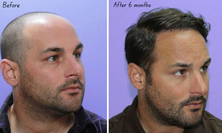 Beste Klinik für Haartransplantation in Istanbul Türkei – Istanbul Vita