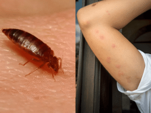 Bettwanzen Bisse Bilder – So erkennst du echte Stiche sofort! bettwanzen bisse bilder