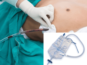 wieviel drainageflüssigkeit ist normal