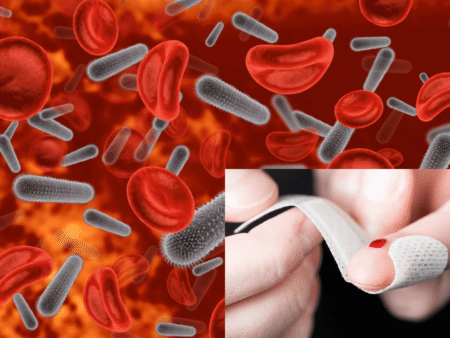 Blutvergiftungslinie – Erkennen, Ursachen und Behandlung einfach erklärt! blutvergiftung strich