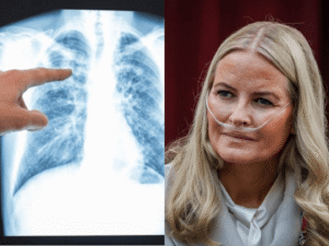 Mette-Marits Lungenerkrankung: Was ist offiziell bekannt? mette marit lunge